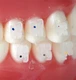 Orthodontic Clear Brackets Roth .018 Slot With Hooks 3,4&5 Ceramic 1 case 20 pc 